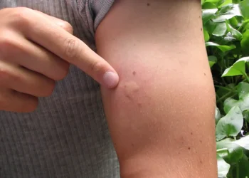¿Sirven los repelentes durante el verano?
