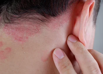 Psoriasis: científicos chilenos solucionan síntomas