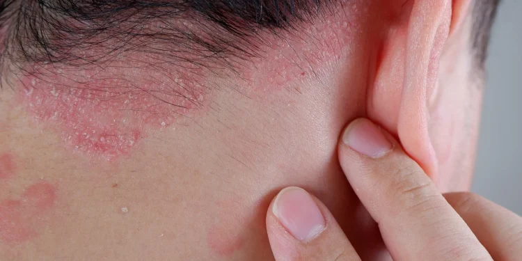 Psoriasis: científicos chilenos solucionan síntomas