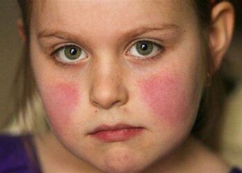 Alerta en Victoria: detectan 10 casos de la «enfermedad de la bofetada» en colegio local